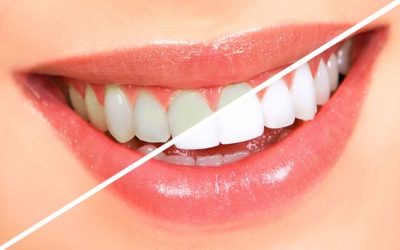 Recomendaciones previas y posteriores al aclaramiento dental