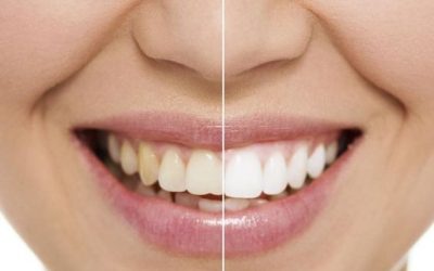Aclaramiento dental, ¡Sonrisa más segura con dientes más blancos!