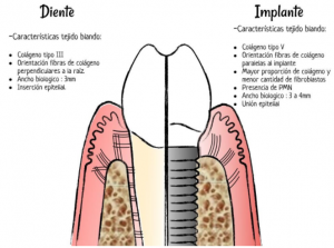 #clinicaoc-diferencia-del-implante-dental-en-tejido-blando