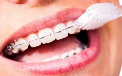 Recomendaciones generales para pacientes de ortodoncia